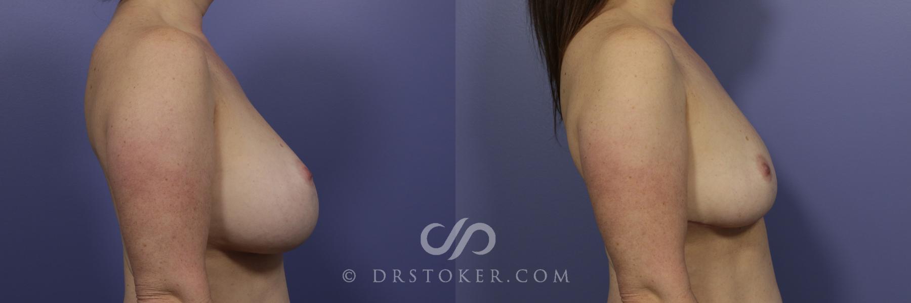Before & After Breast Implant Correction Case 958 View #3 View in Los Angeles, CA