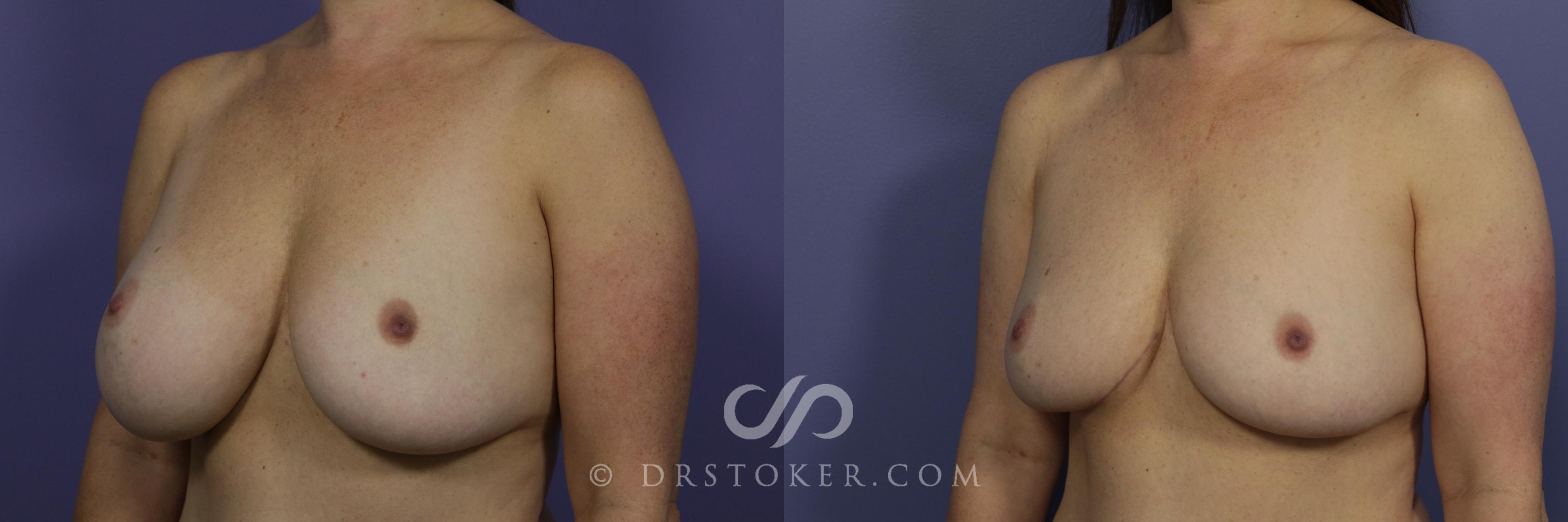 Before & After Breast Implant Correction Case 958 View #4 View in Los Angeles, CA