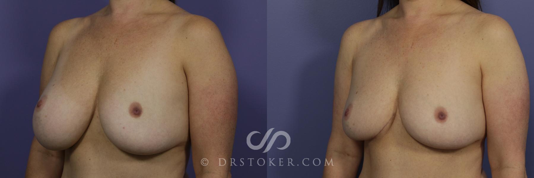 Before & After Breast Implant Correction Case 958 View #4 View in Los Angeles, CA