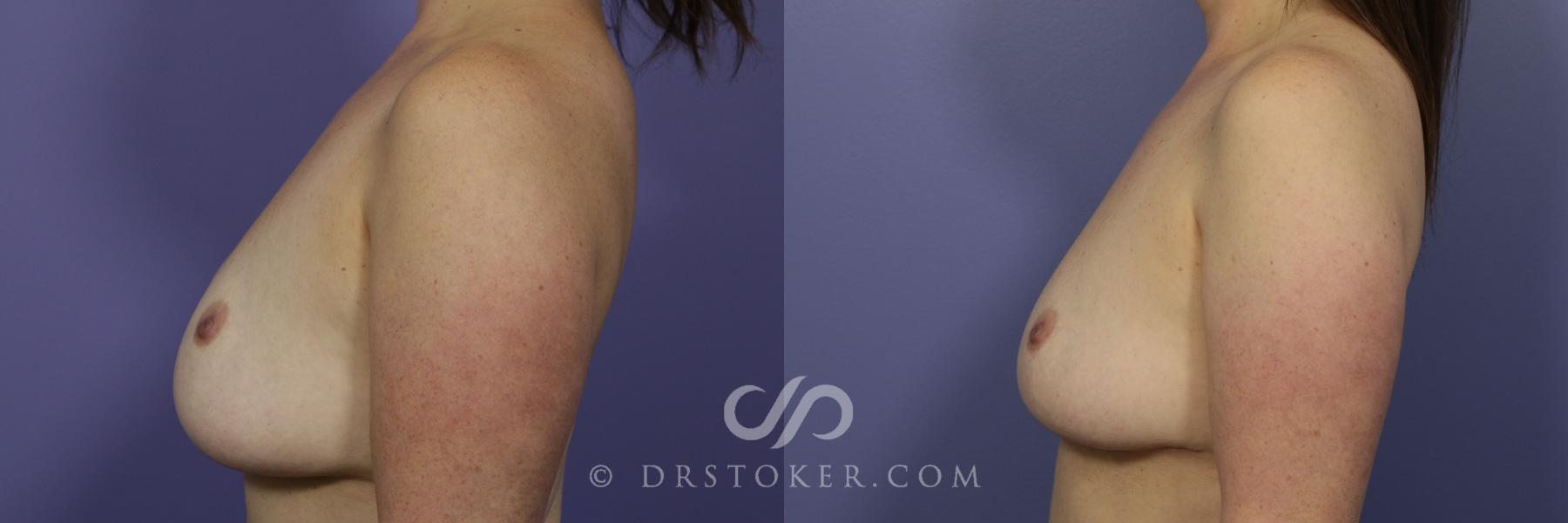 Before & After Breast Implant Correction Case 958 View #5 View in Los Angeles, CA