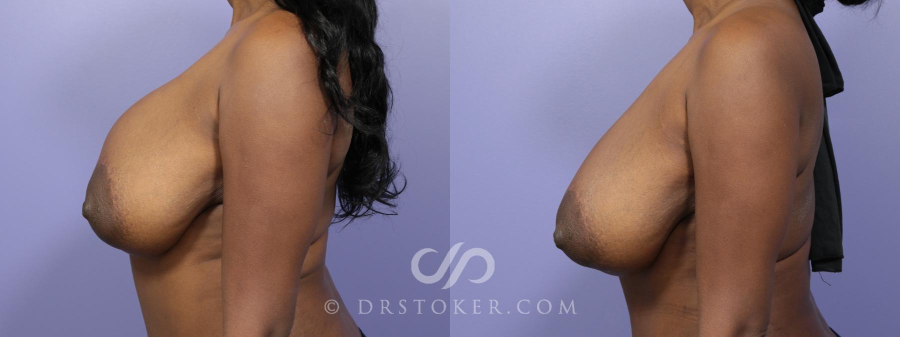 Before & After Breast Implant Correction Case 959 View #3 View in Los Angeles, CA