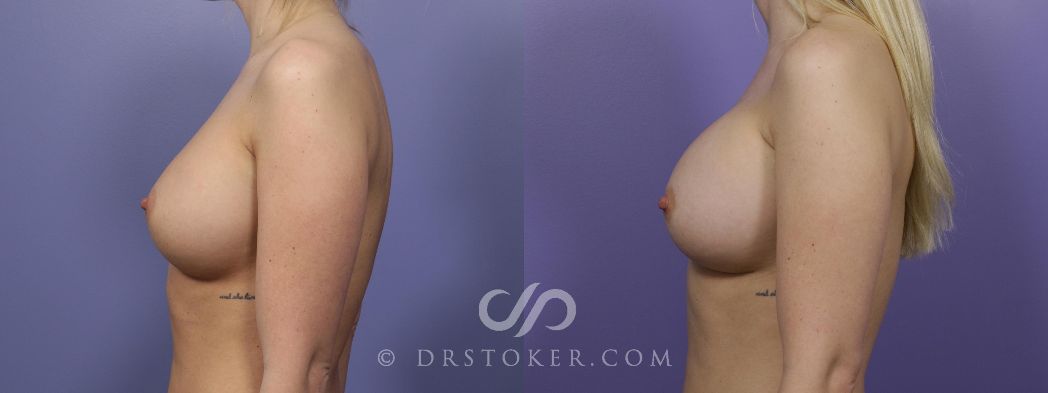 Before & After Breast Implant Correction Case 960 View #3 View in Los Angeles, CA