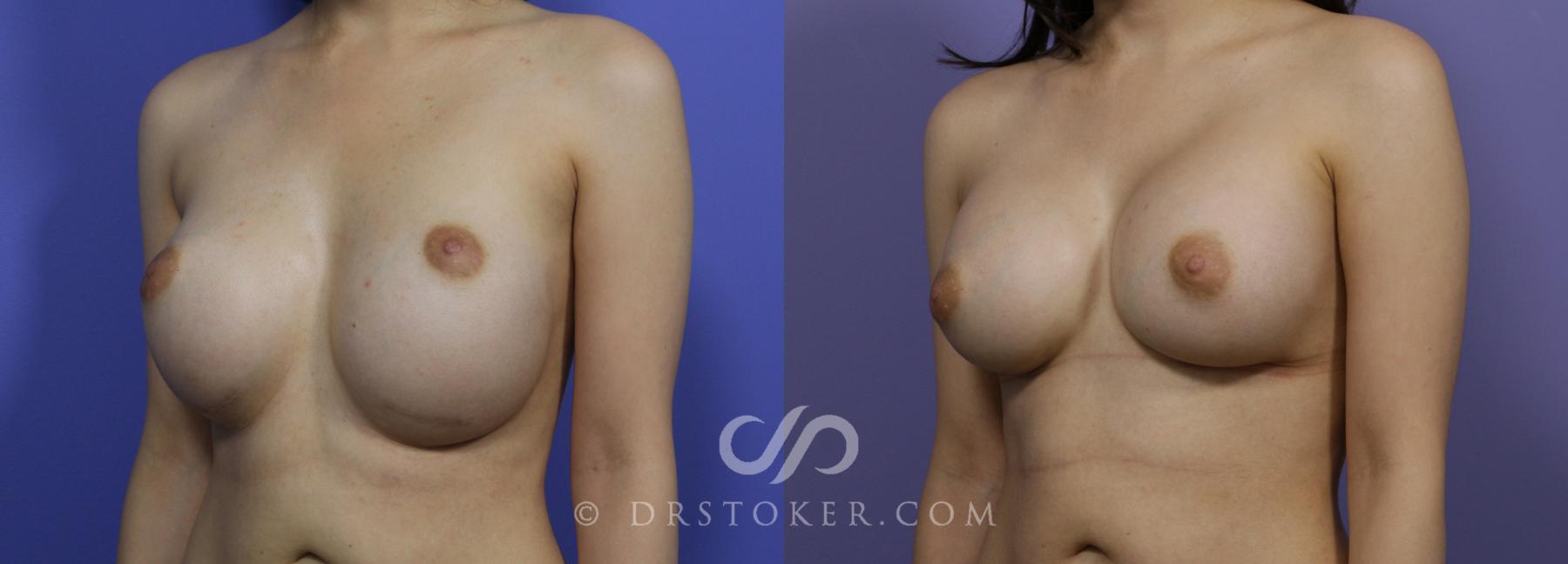 Before & After Breast Implant Correction Case 962 View #1 View in Los Angeles, CA