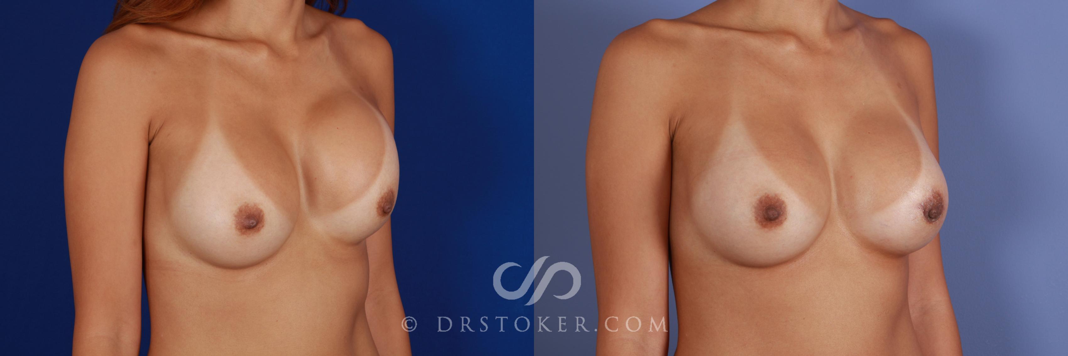 Before & After Breast Implant Correction Case 963 View #2 View in Los Angeles, CA