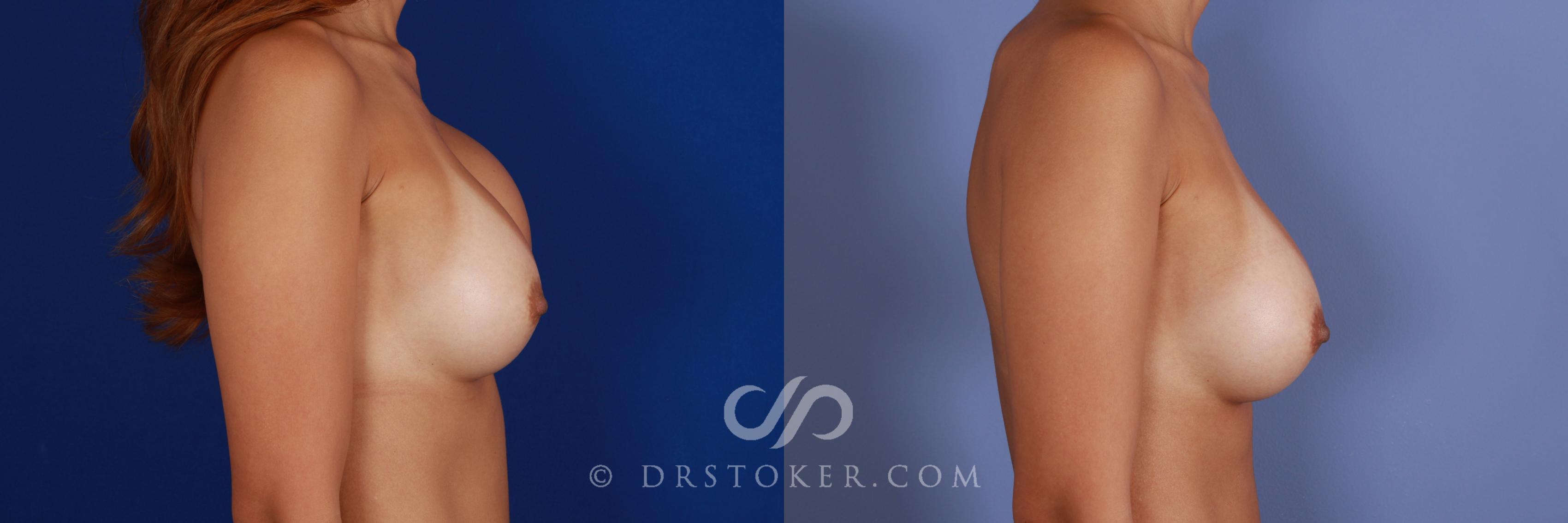 Before & After Breast Implant Correction Case 963 View #3 View in Los Angeles, CA