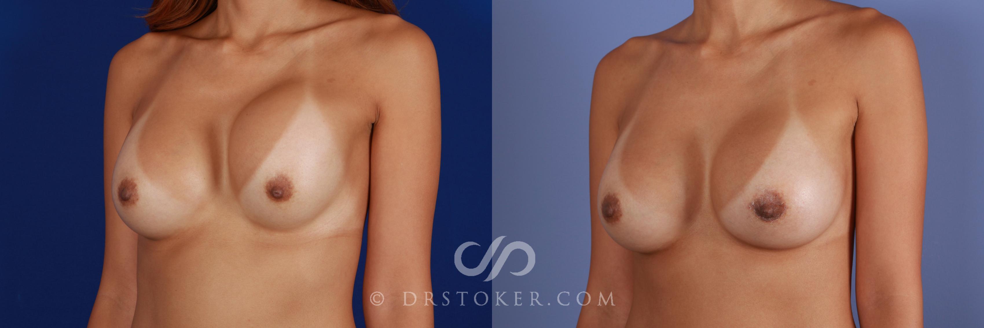 Before & After Breast Implant Correction Case 964 View #1 View in Los Angeles, CA