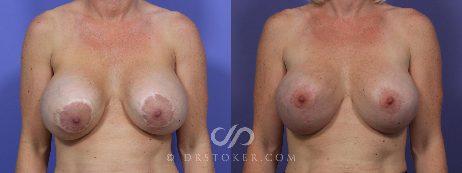Before & After Breast Implant Correction Case 967 View #1 View in Los Angeles, CA