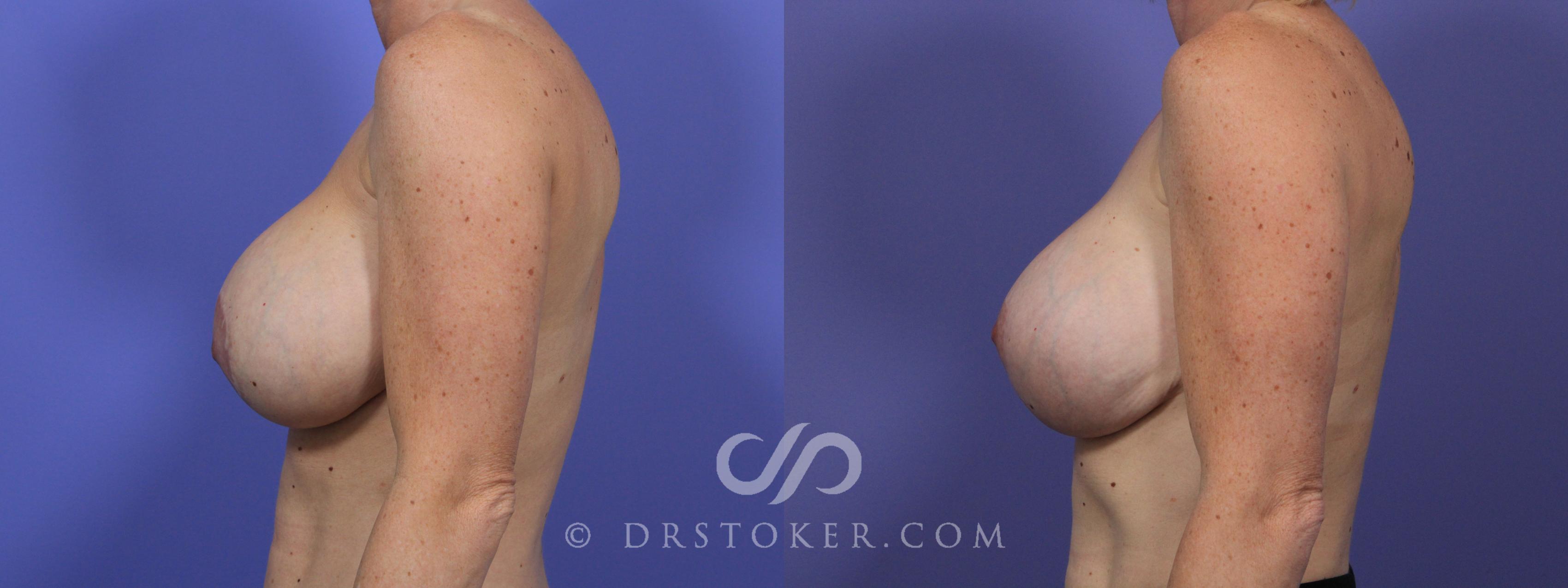 Before & After Breast Implant Correction Case 967 View #2 View in Los Angeles, CA