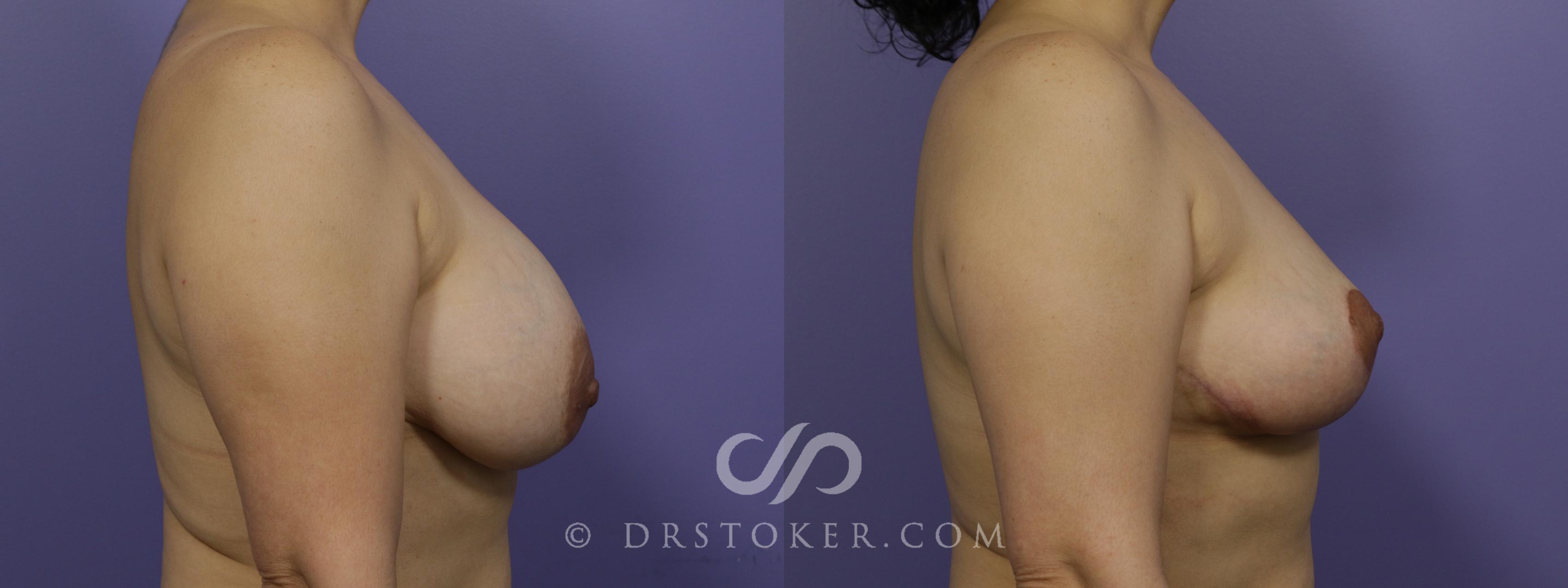 Before & After Breast Implant Removal Case 1277 View #3 View in Los Angeles, CA