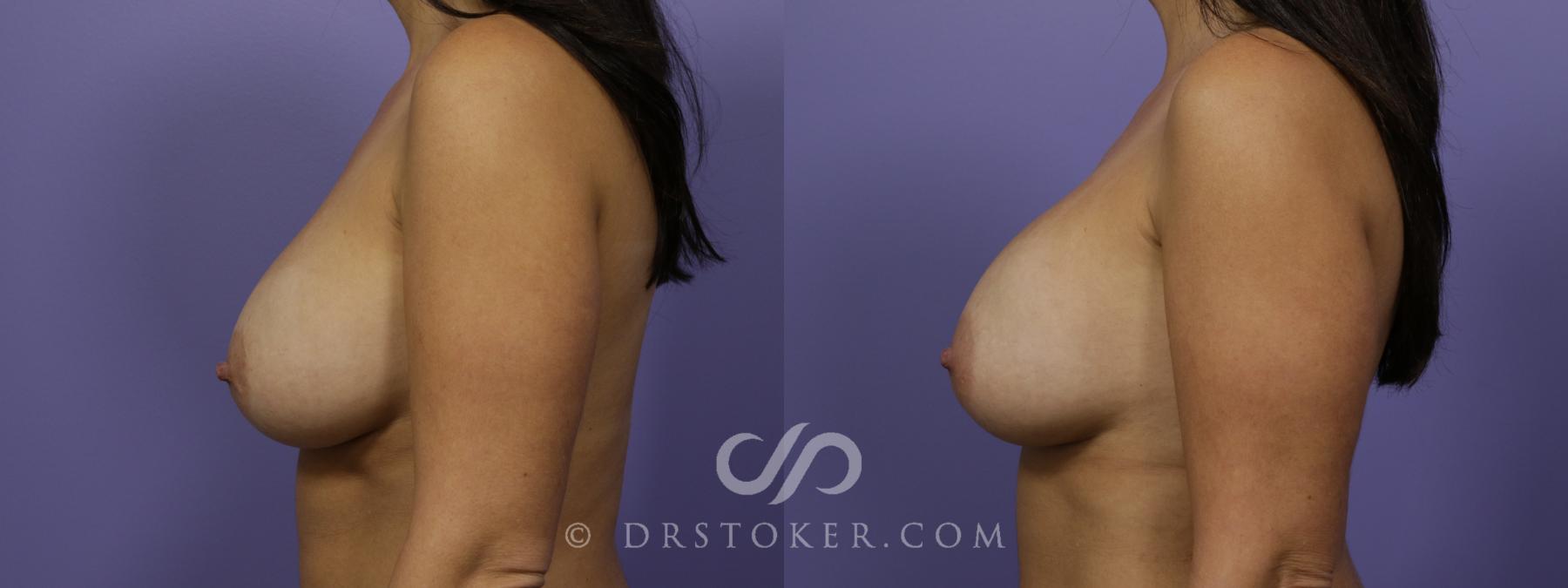 Before & After Breast Implant Removal Case 1367 View #4 View in Los Angeles, CA