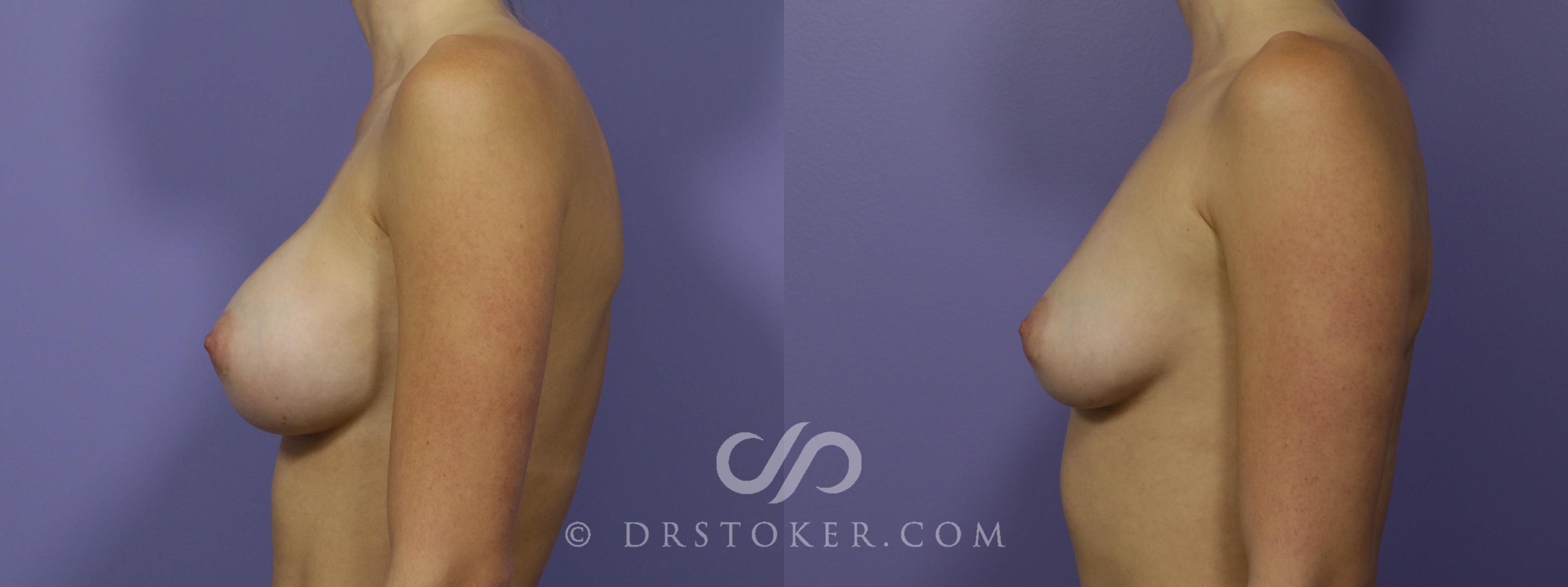 Before & After Breast Implant Removal Case 1475 View #5 View in Los Angeles, CA