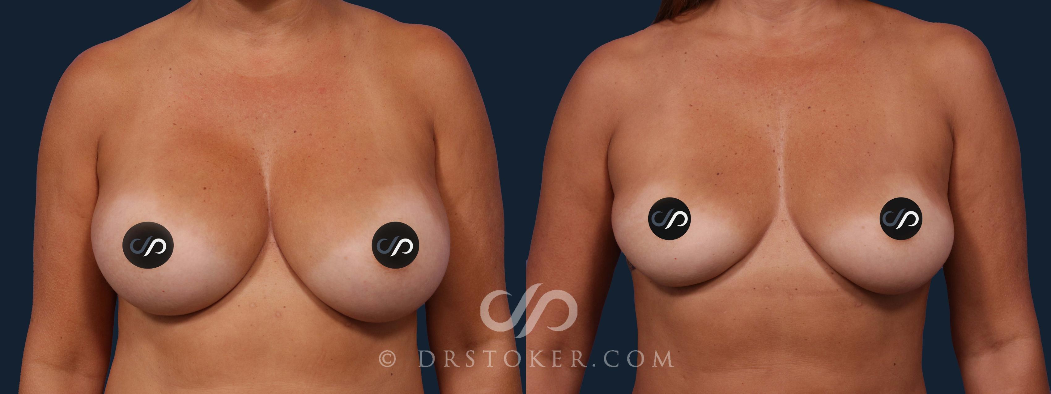 Before & After Breast Implant Removal Case 2021 Front View in Marina del Rey, CA