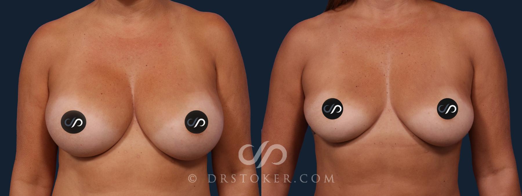 Before & After Breast Implant Removal Case 2021 Front View in Los Angeles, CA