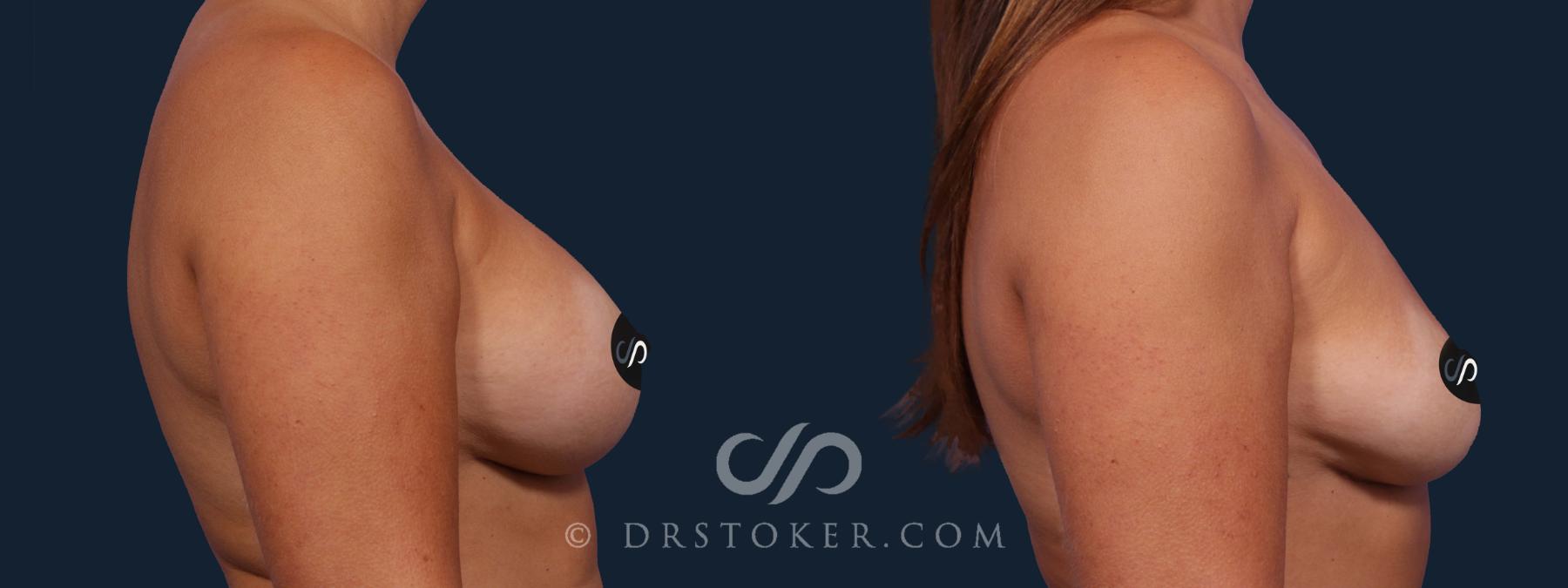 Before & After Breast Implant Removal Case 2021 Right Side View in Los Angeles, CA