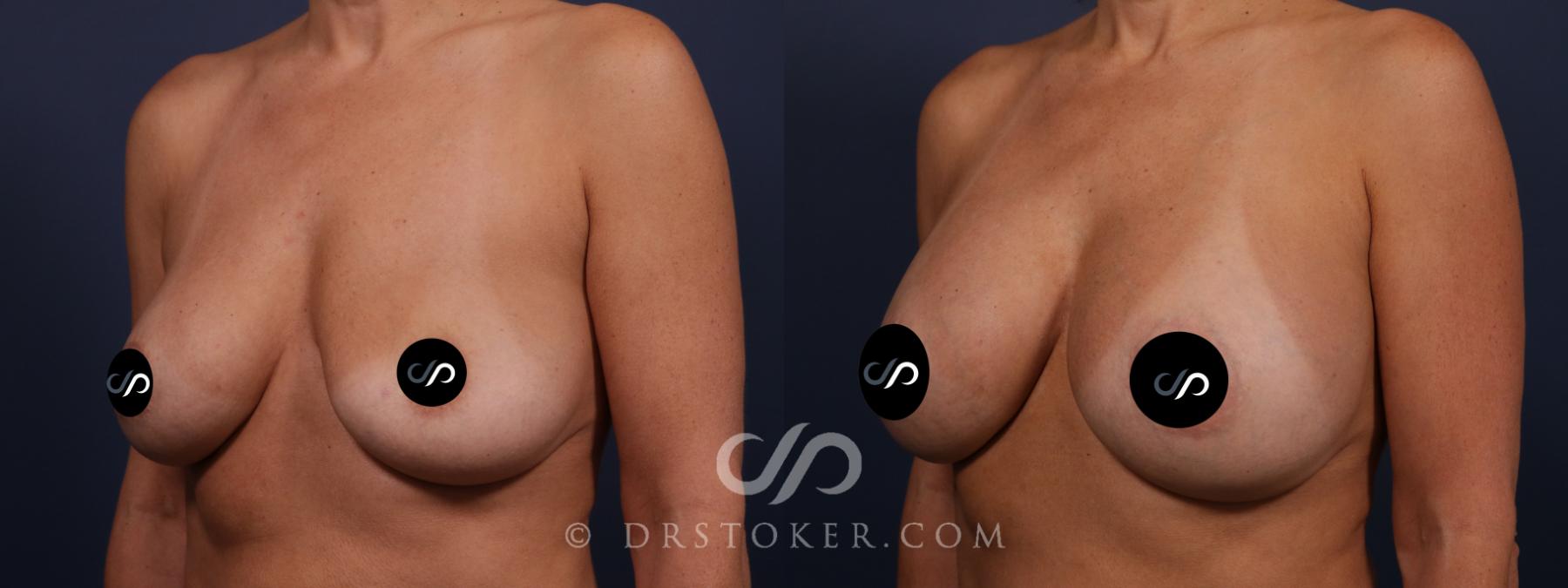 Before & After Breast Implant Removal Case 2675 Left Oblique View in Los Angeles, CA