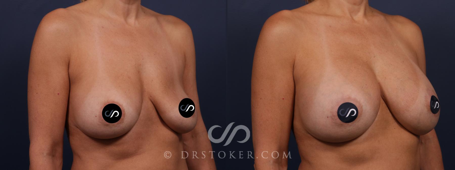 Before & After Breast Implant Removal Case 2675 Right Oblique View in Los Angeles, CA