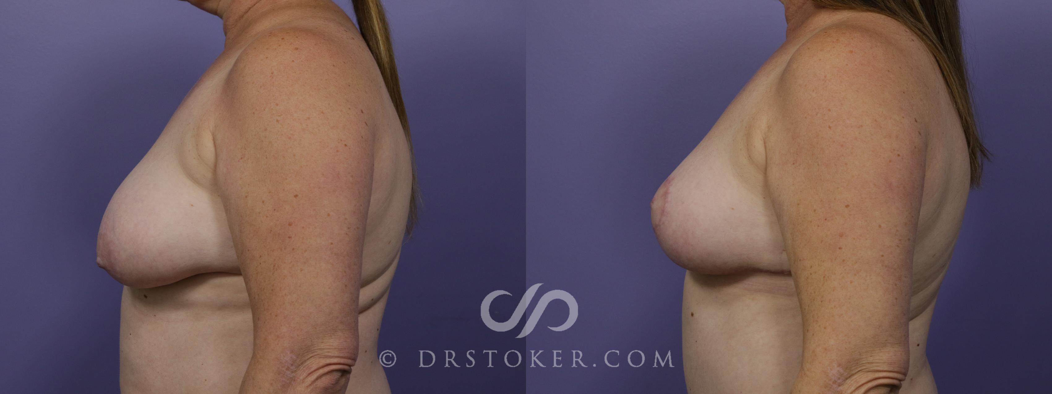 Before & After Breast Lift Case 1278 View #1 View in Los Angeles, CA