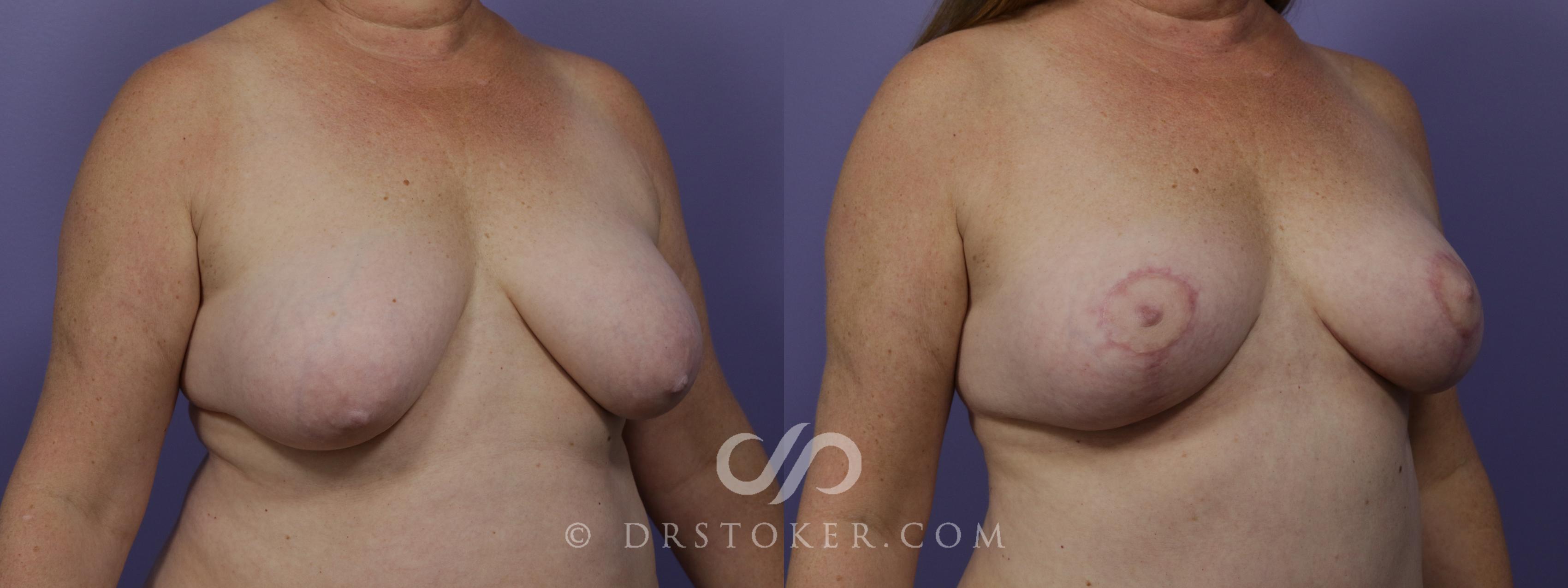 Before & After Breast Lift Case 1278 View #4 View in Los Angeles, CA