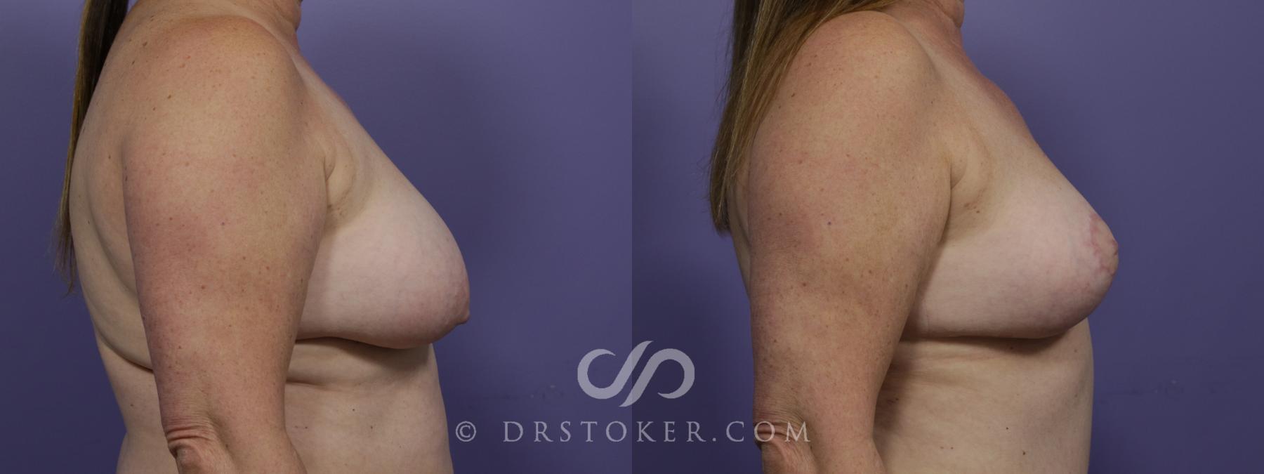 Before & After Breast Lift Case 1278 View #5 View in Los Angeles, CA