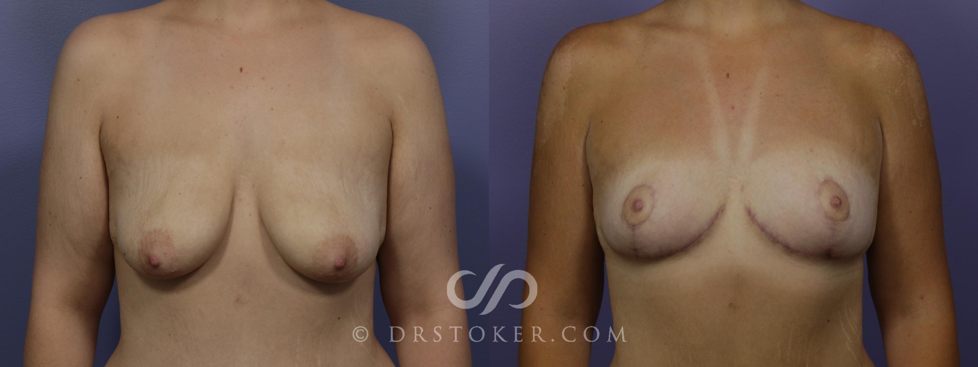 Before & After Breast Lift Case 1410 View #1 View in Los Angeles, CA