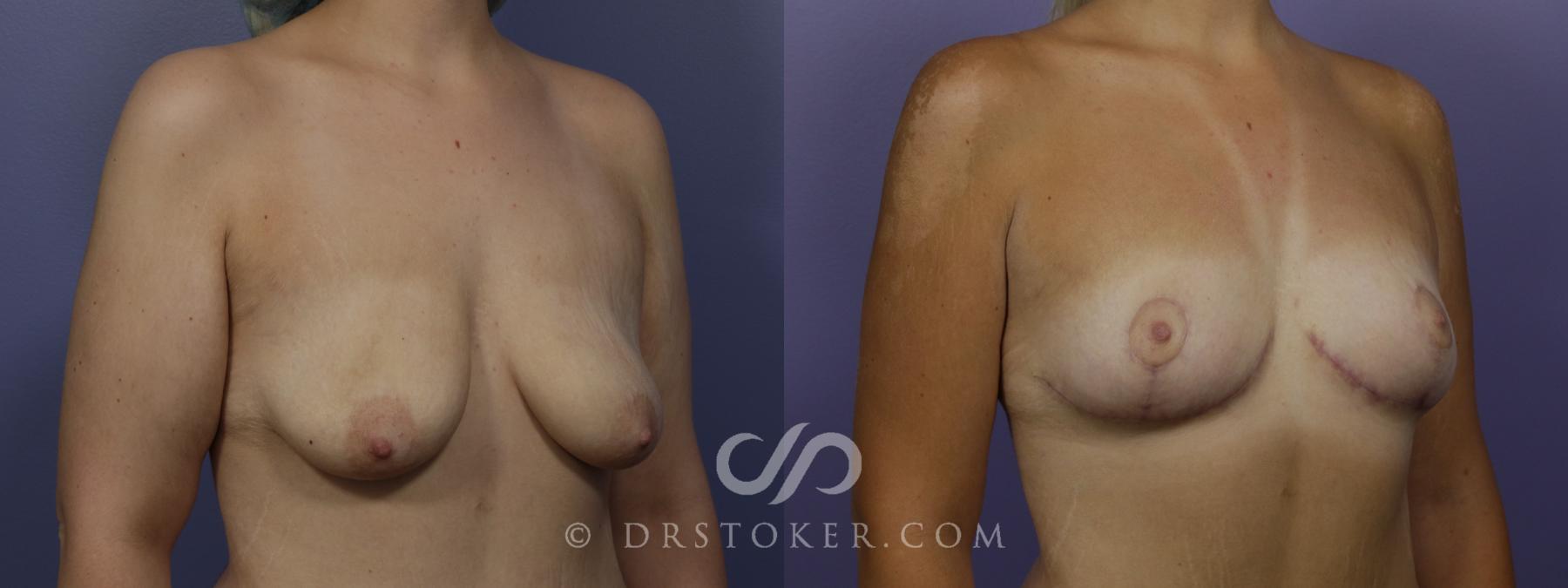 Before & After Breast Lift Case 1410 View #2 View in Los Angeles, CA