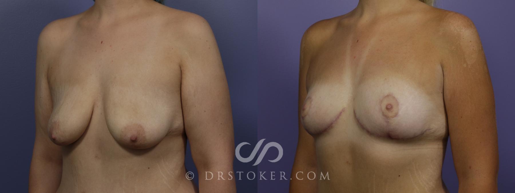 Before & After Breast Lift Case 1410 View #4 View in Los Angeles, CA