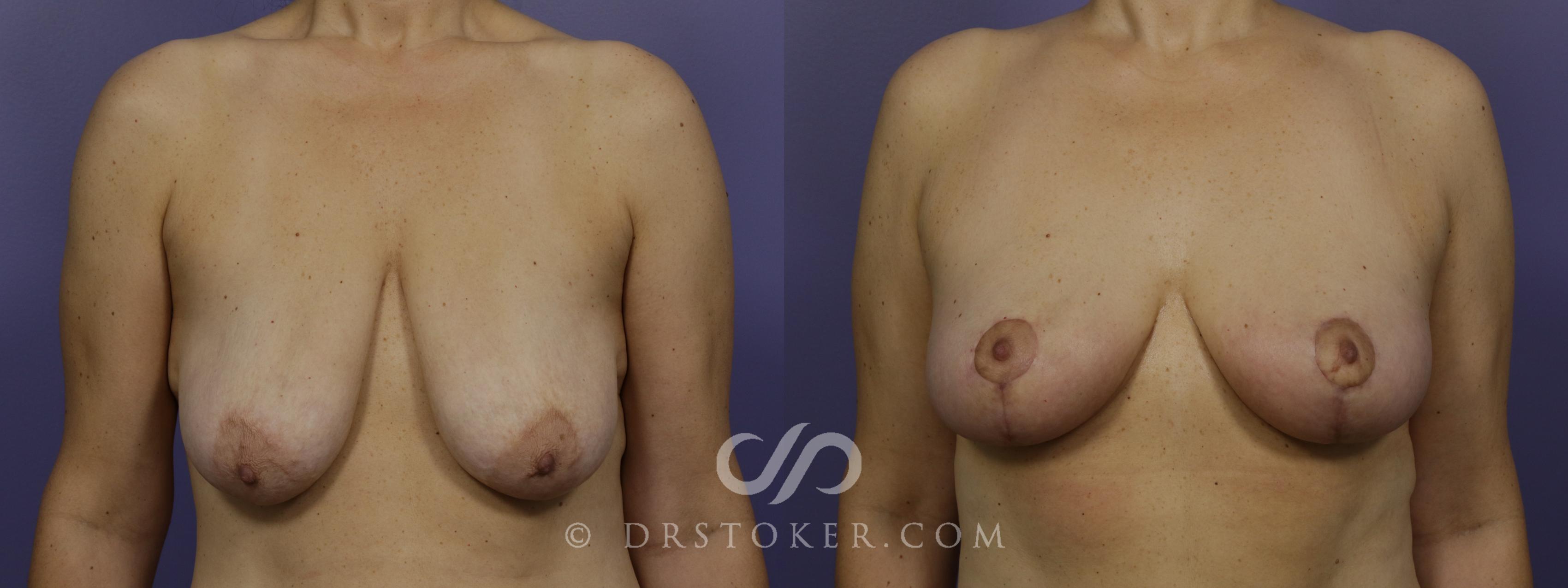Before & After Breast Lift Case 1411 View #1 View in Los Angeles, CA