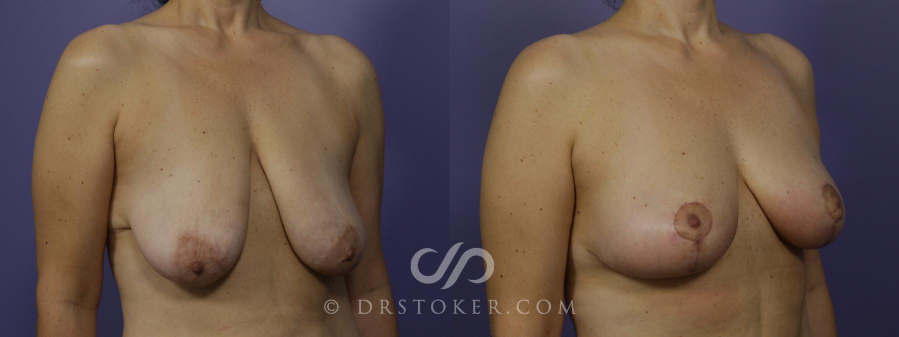 Before & After Breast Lift Case 1411 View #2 View in Los Angeles, CA