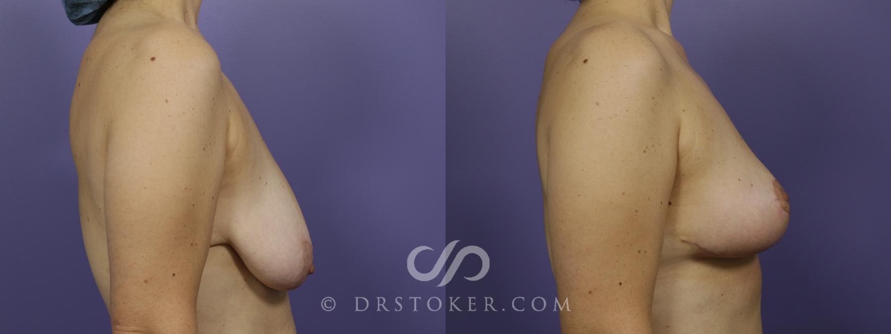 Before & After Breast Lift Case 1411 View #3 View in Los Angeles, CA