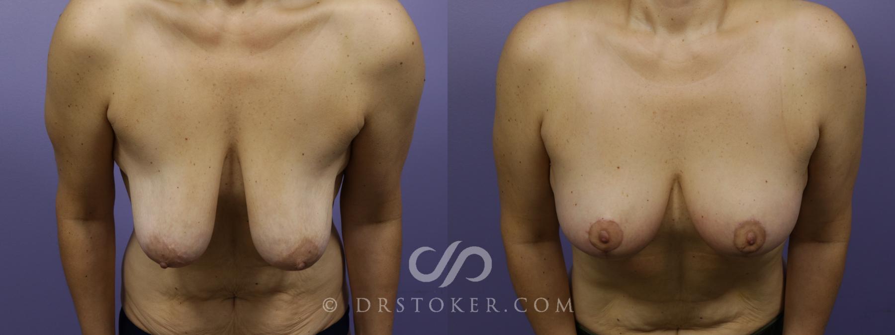 Before & After Breast Lift Case 1411 View #4 View in Los Angeles, CA