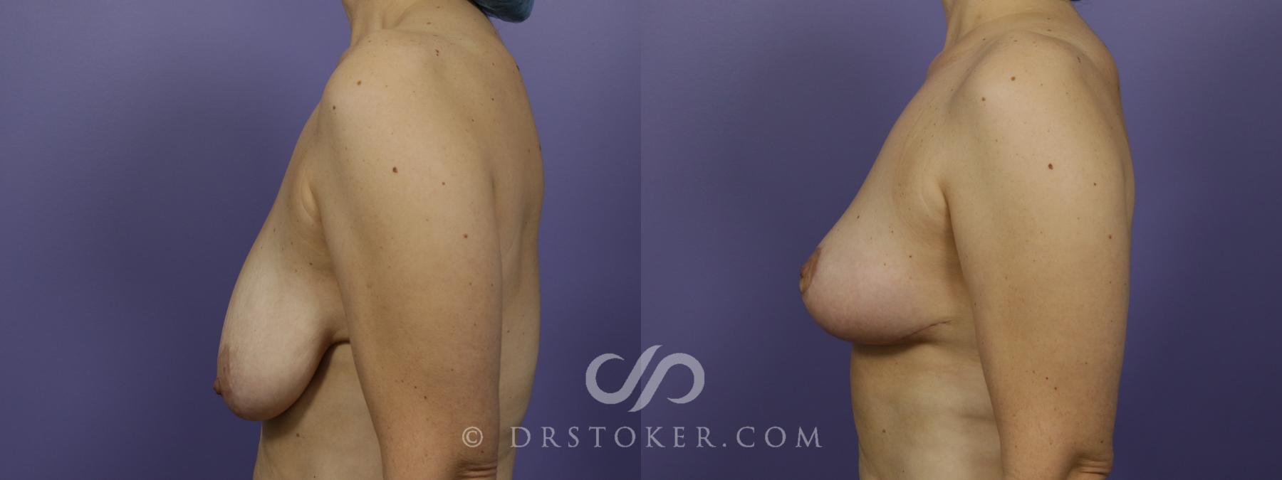 Before & After Breast Lift Case 1411 View #6 View in Los Angeles, CA