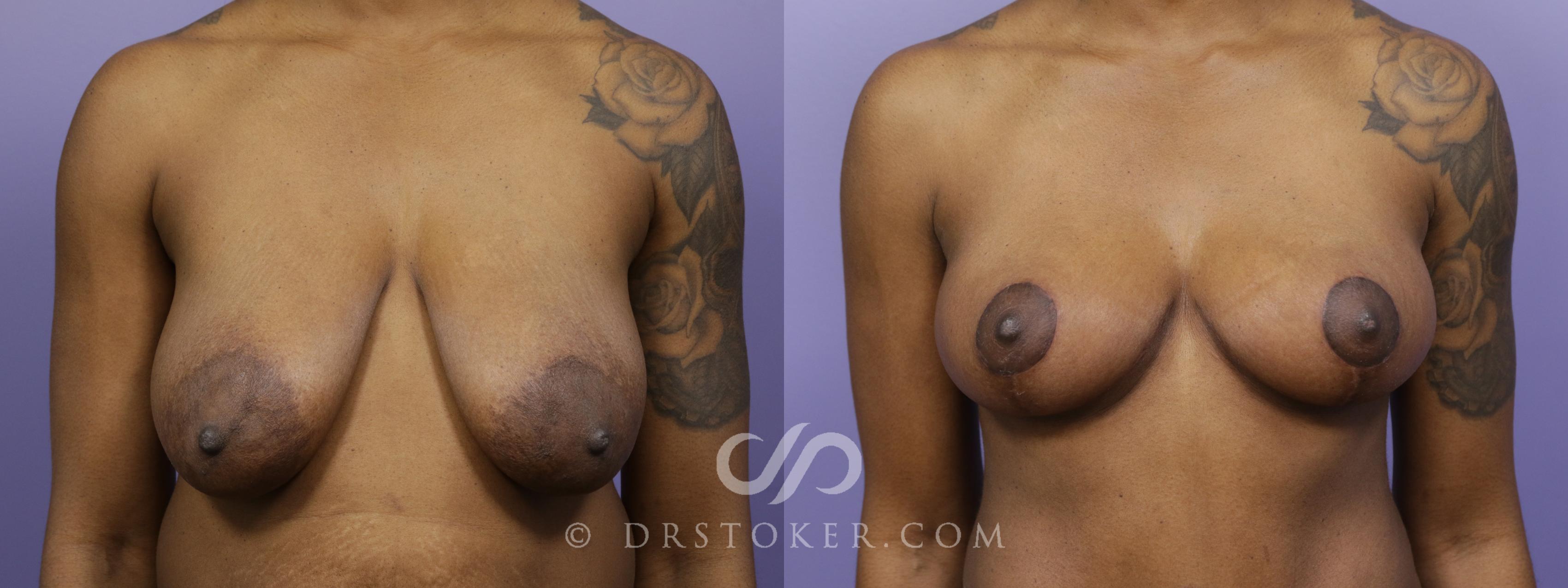 Before & After Breast Lift Case 1520 View #1 View in Marina del Rey, CA