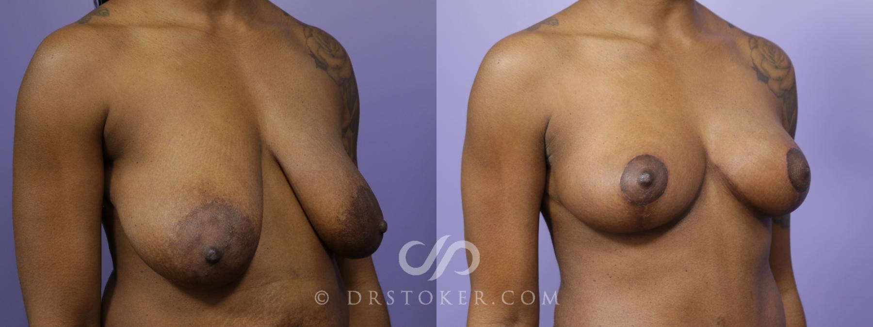 Before & After Breast Lift Case 1520 View #2 View in Los Angeles, CA
