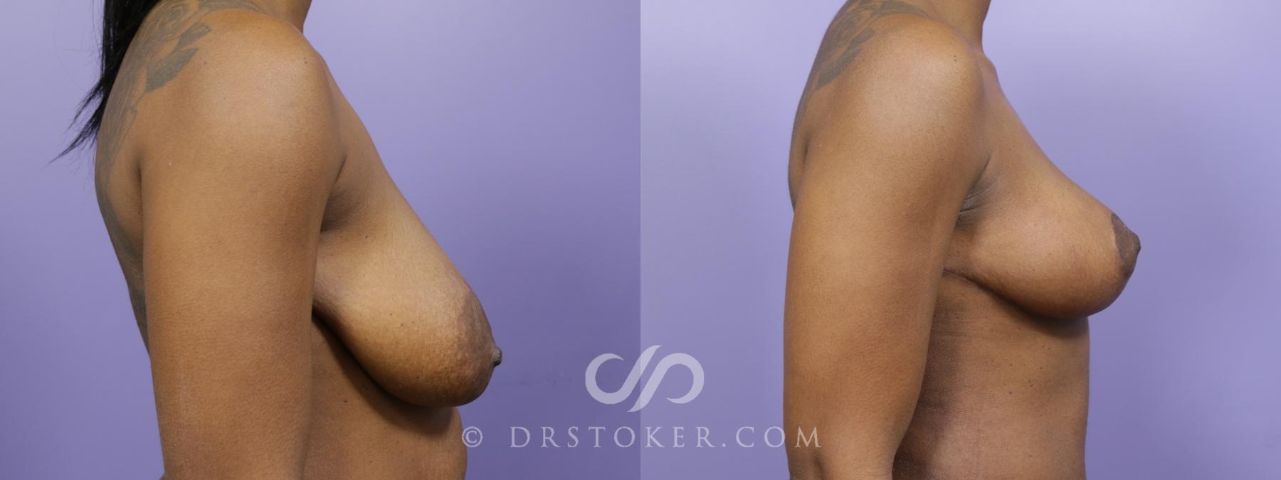 Before & After Breast Lift Case 1520 View #3 View in Los Angeles, CA