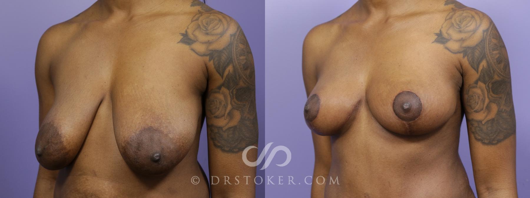 Before & After Breast Lift Case 1520 View #4 View in Los Angeles, CA