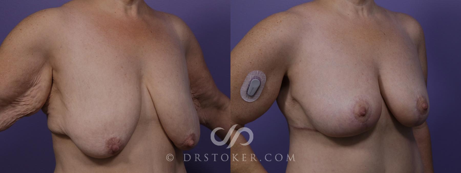 Before & After Breast Lift Case 1729 View #2 View in Los Angeles, CA