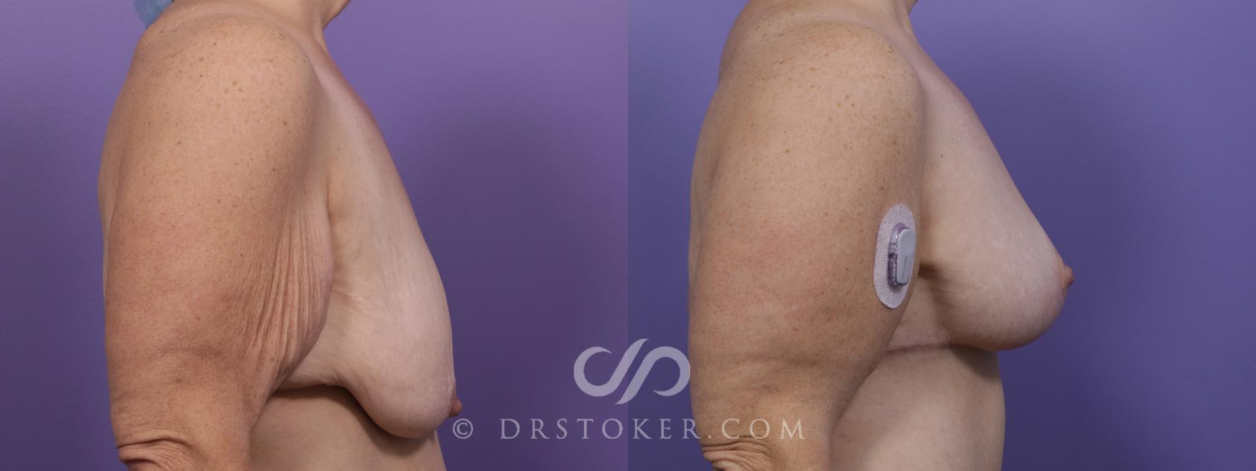 Before & After Breast Lift Case 1729 View #3 View in Los Angeles, CA