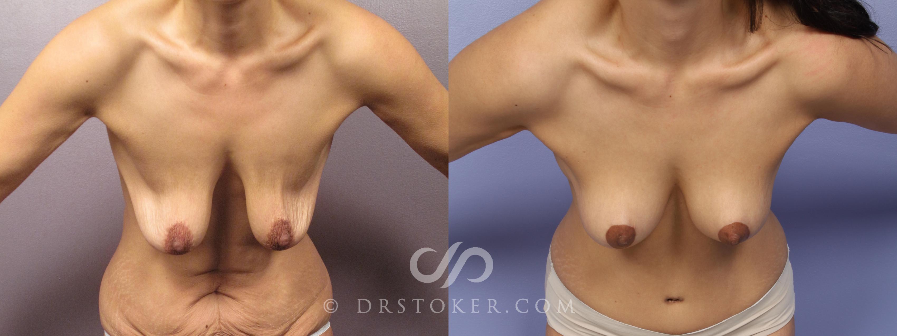 Before & After Breast Lift Case 1730 View #1 View in Los Angeles, CA