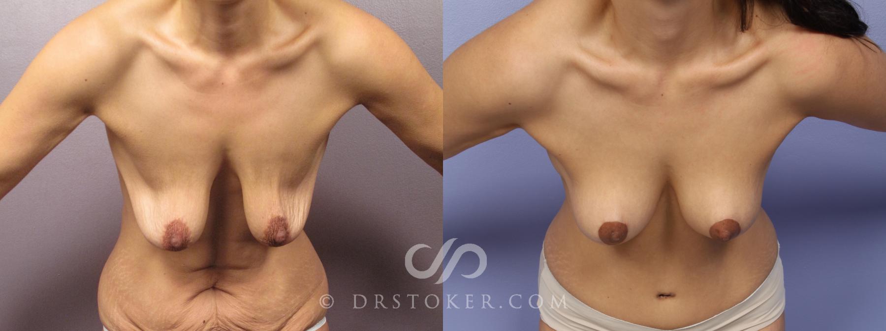 Before & After Breast Lift Case 1730 View #1 View in Los Angeles, CA