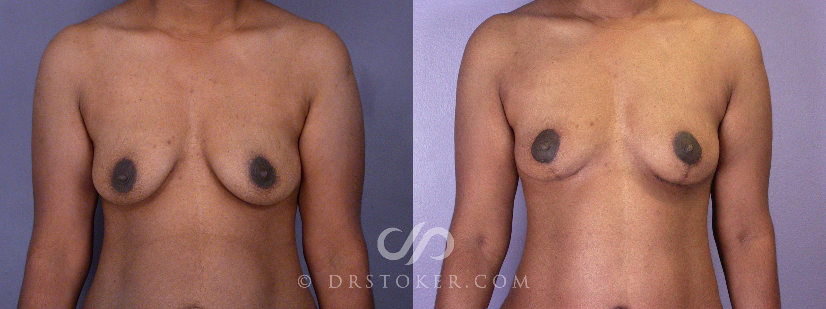 Before & After Breast Lift Case 1731 View #1 View in Los Angeles, CA