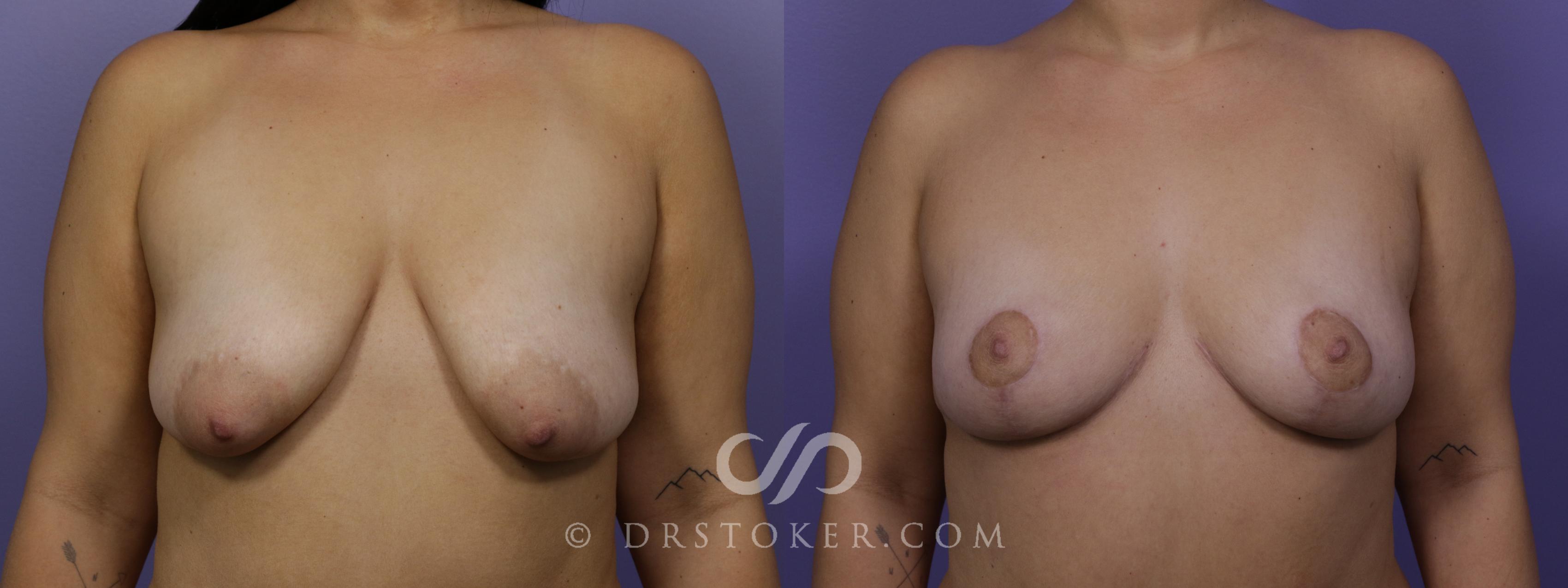 Before & After Breast Lift Case 1741 View #1 View in Los Angeles, CA