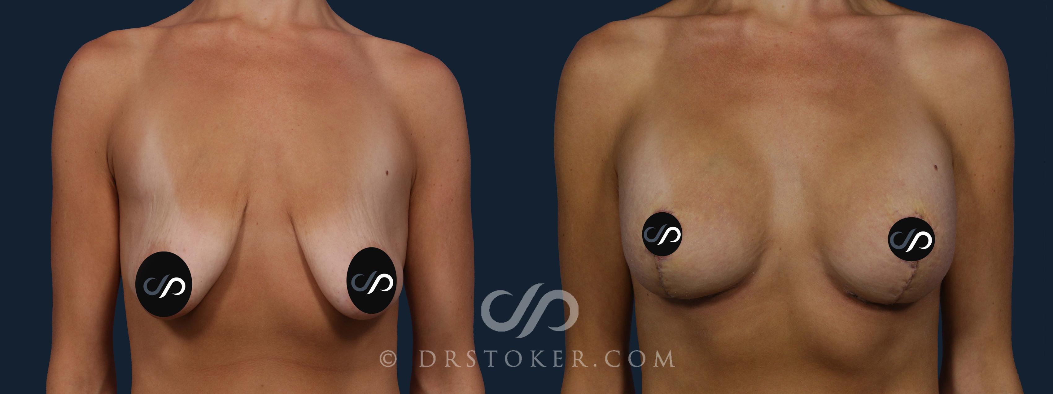 Before & After Breast Lift Case 1910 Front View in Los Angeles, CA