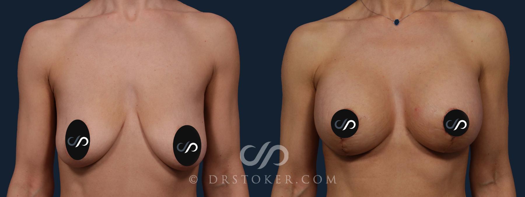 Before & After Breast Lift Case 1915 Front View in Los Angeles, CA