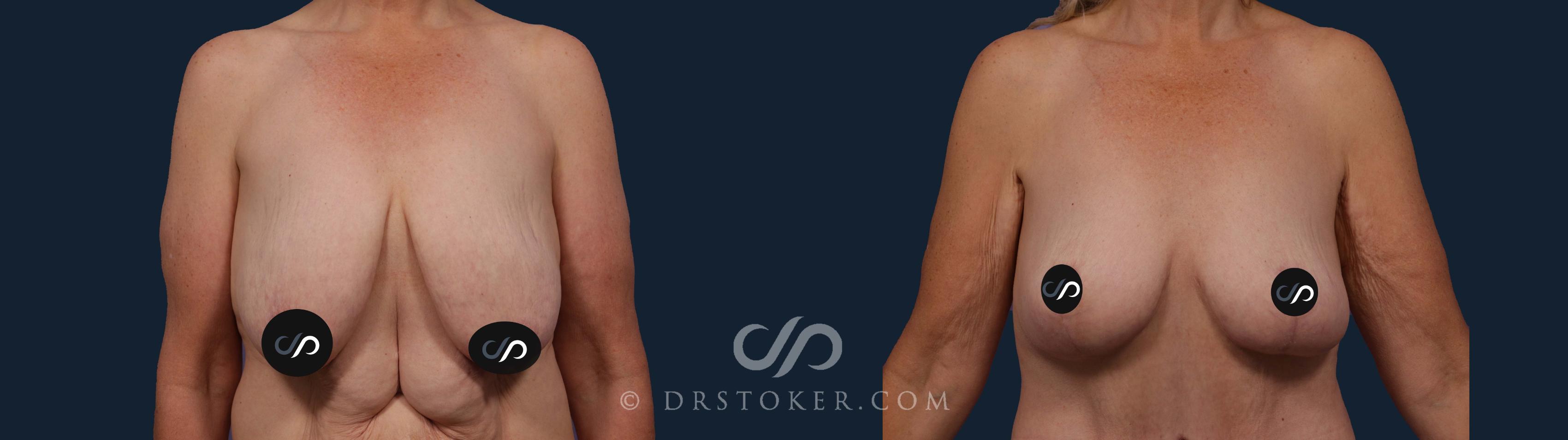 Before & After Breast Lift Case 1917 Front View in Los Angeles, CA