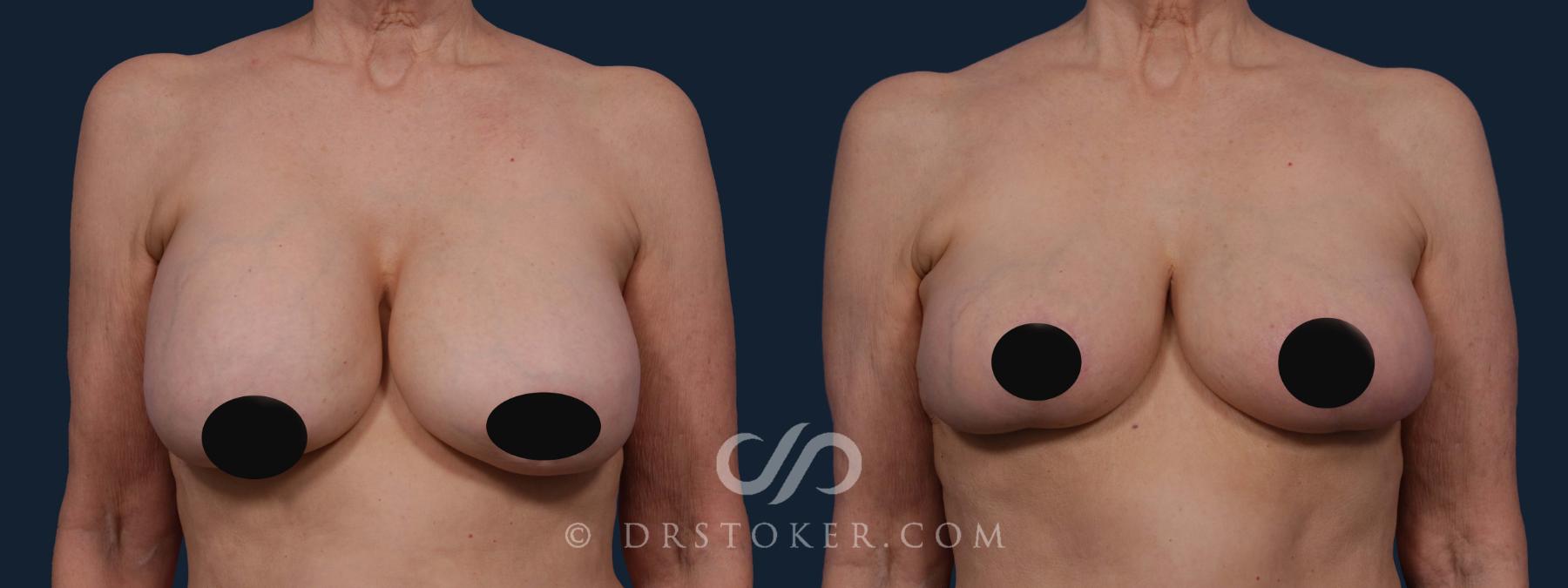 Before & After Breast Lift Case 1928 Front View in Los Angeles, CA