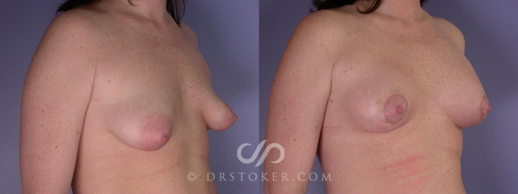 Before & After Breast Lift Case 193 View #2 View in Los Angeles, CA