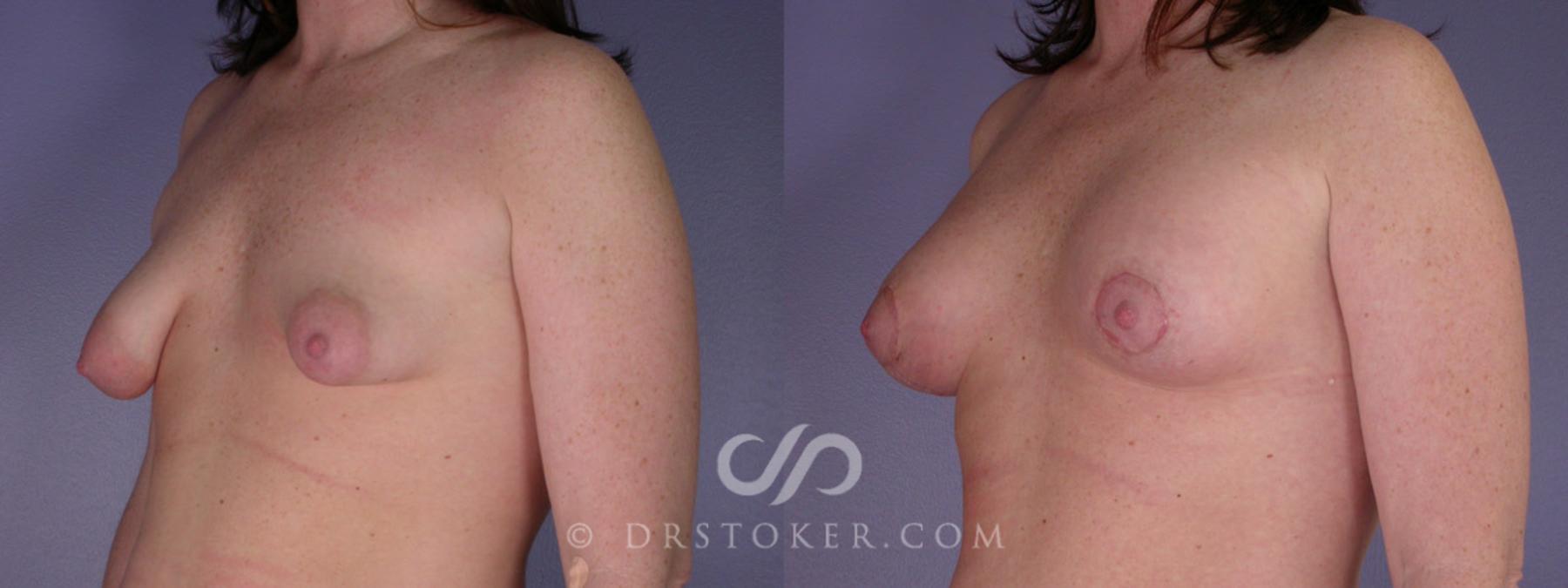 Before & After Breast Lift Case 193 View #3 View in Los Angeles, CA