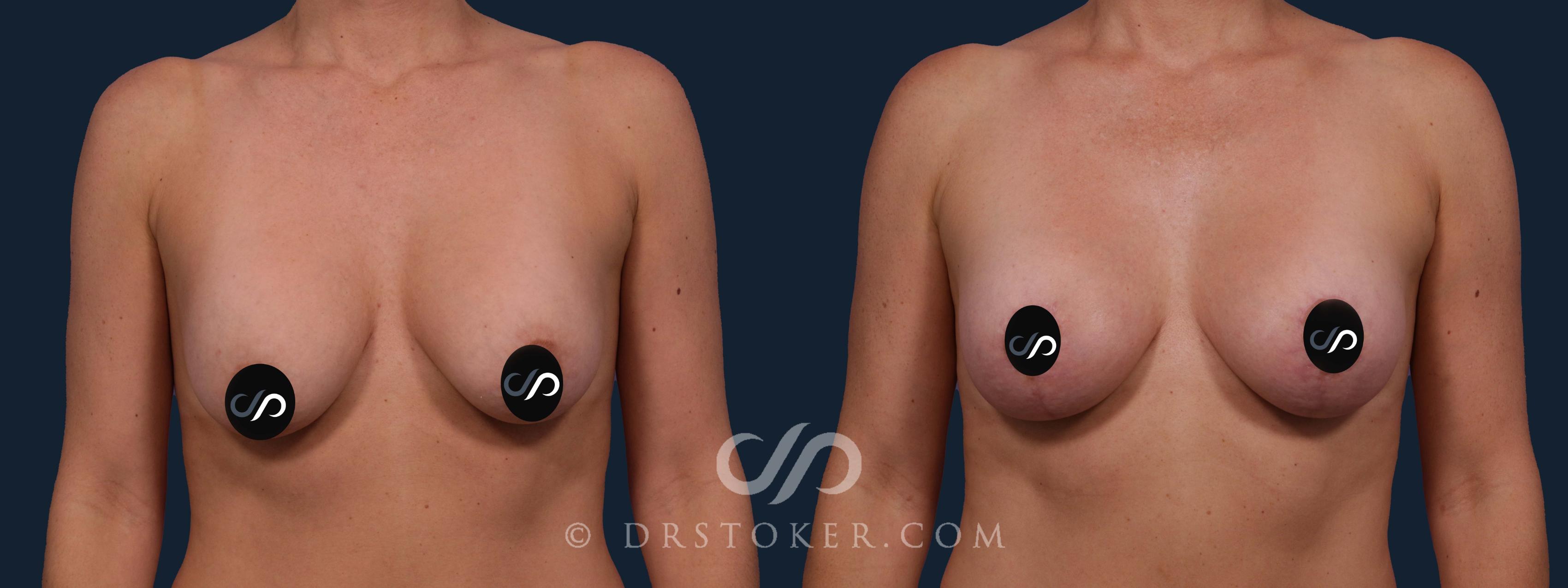 Before & After Breast Lift Case 1930 Front View in Los Angeles, CA