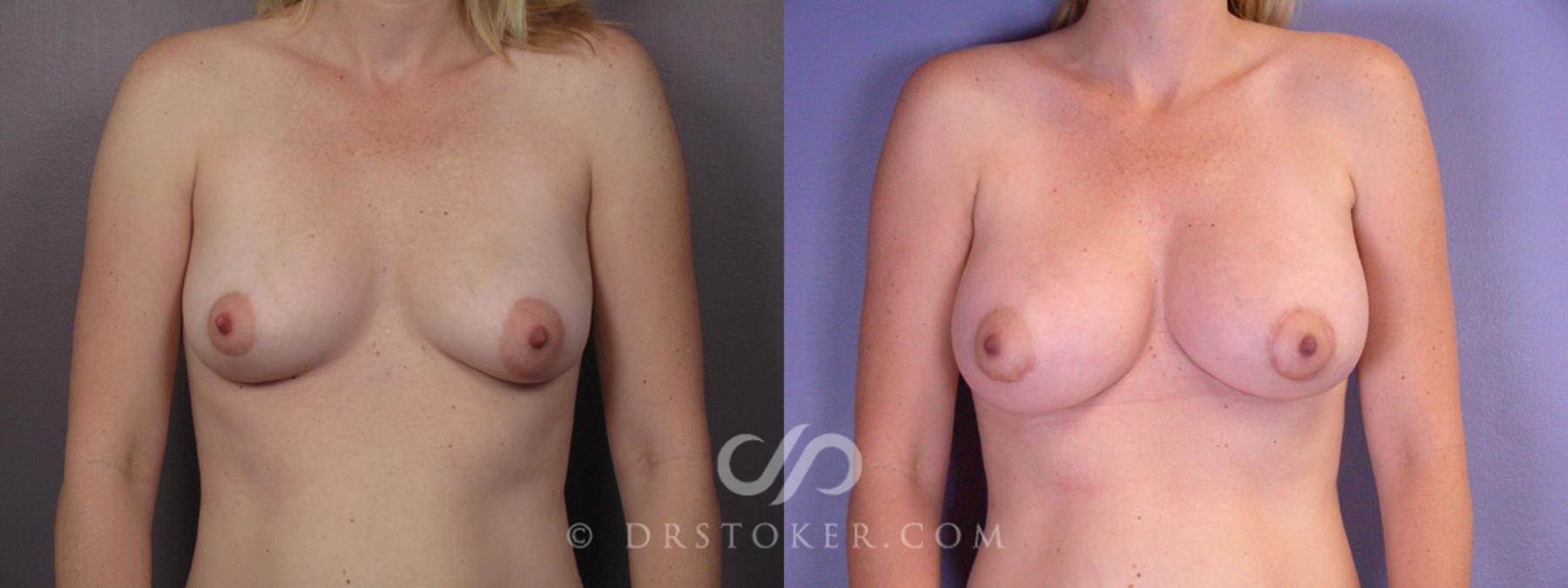 Before & After Breast Augmentation, Rapid Recovery Case 194 View #1 View in Los Angeles, CA