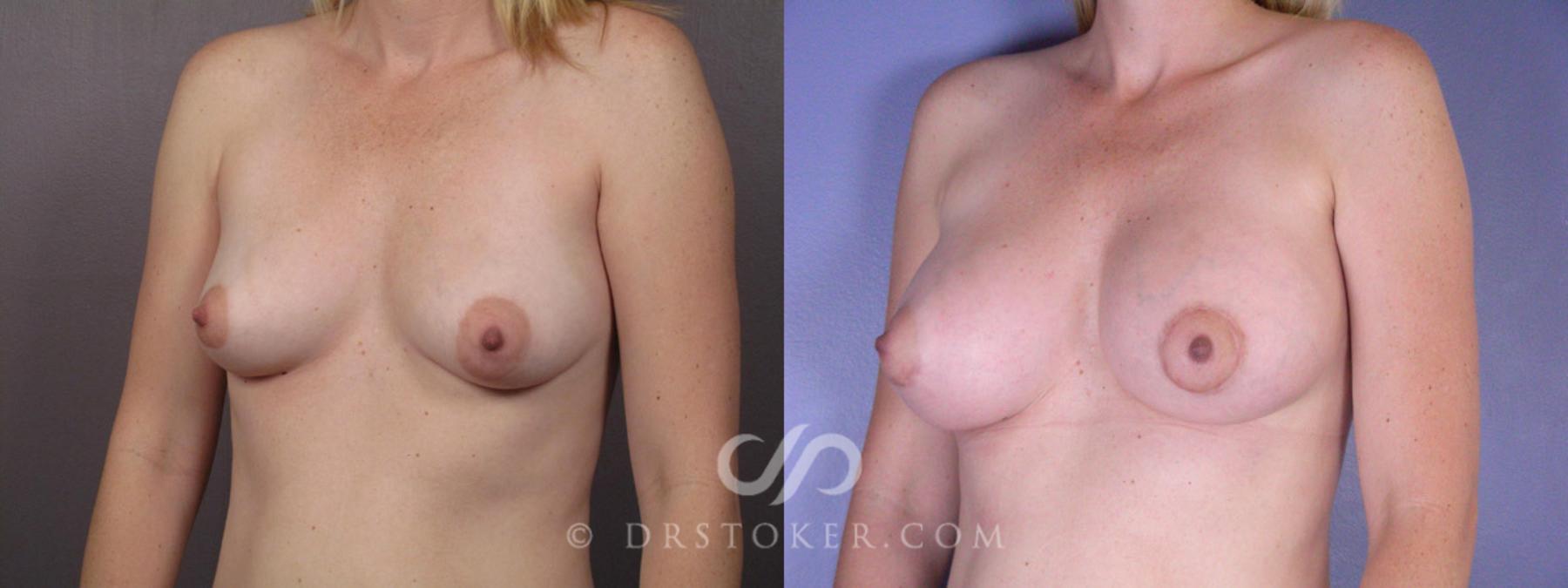 Before & After Breast Lift Case 194 View #3 View in Los Angeles, CA